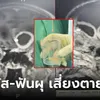 หมอเตือนแล้วนะ! อย่าวางใจไซนัสอักเสบ-ฟันผุ เสี่ยงอันตรายถึงชีวิต